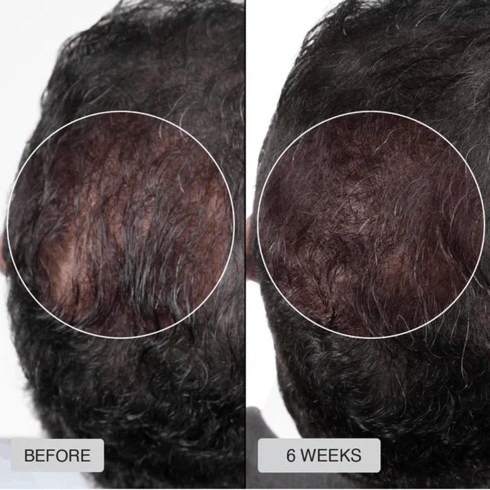 Clinically Inspired Red Light Therapy Cap for Hair Regrowth