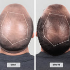 Clinically Inspired Red Light Therapy Cap for Hair Regrowth