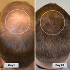 Clinically Inspired Red Light Therapy Cap for Hair Regrowth